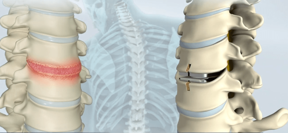 Best Lumbar Spine Surgeons Brooklyn